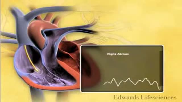 Swan Ganz Physiology