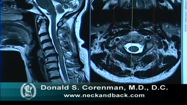 ⁣MRI of Cervical Stenosis