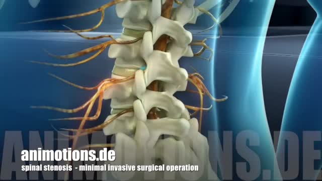 ⁣Spinal Stenosis Surgery