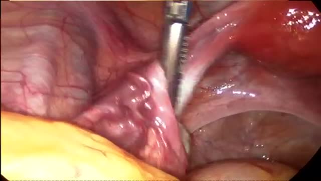 Endometriosis surgery