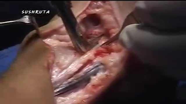 Clubfoot in Surgery