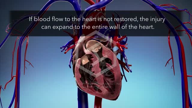 Ventricular Rupture - Cardiac Injury