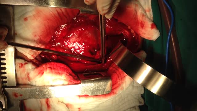 Blunt cardiac rupture