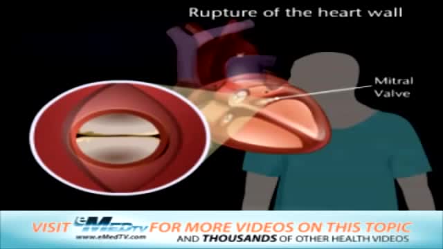 ⁣Rupture of the Heart Wall and Mitral Valve Replacement