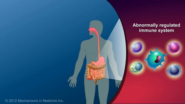 Crohn's Disease