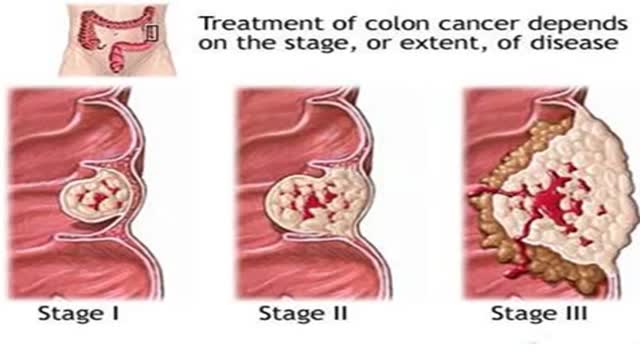 ⁣Colon Cancer symptoms