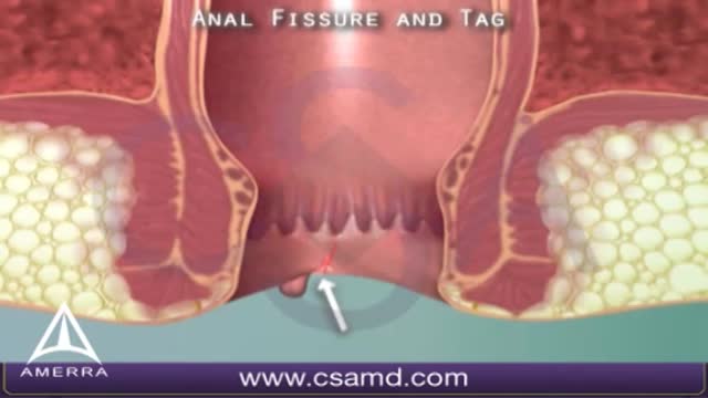 Anal Fissure