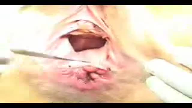 ⁣Complete perineal tear reconstruction