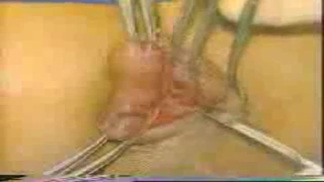 Hemorrhoidectomy