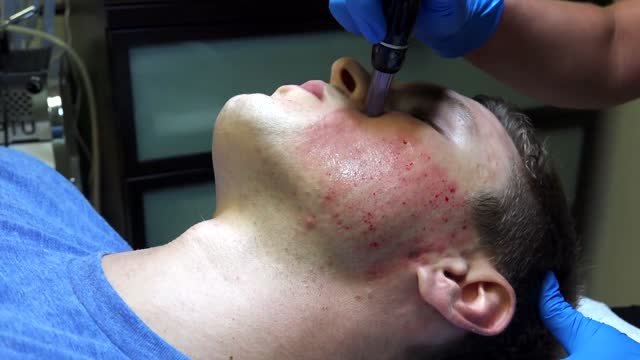 Acne Scar Surgery