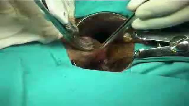 ⁣Hemorrhoidectomy Ligasure