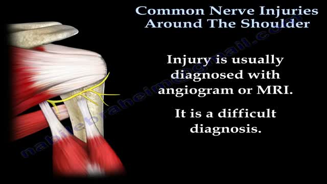 ⁣Shoulder Nerve injury