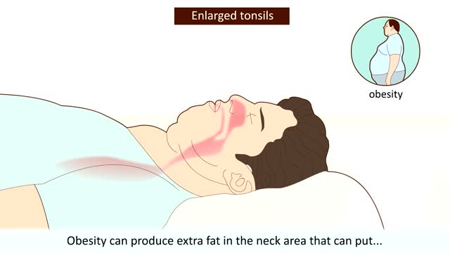 ⁣Obstructive Sleep Apnea Syndrome