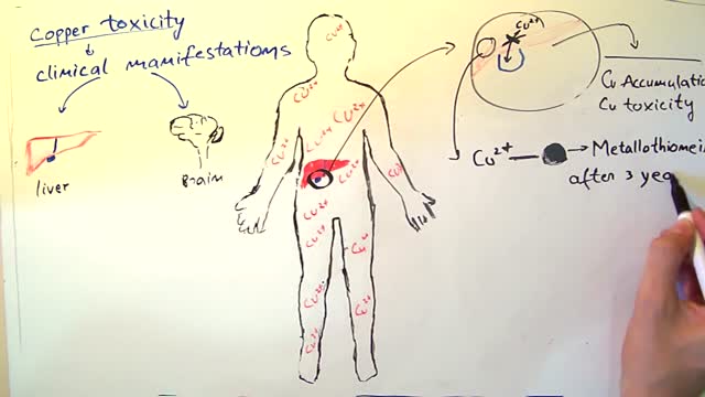 Wilson's Disease