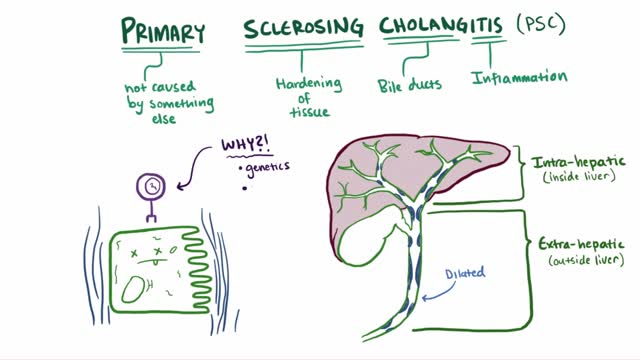 Primary sclerosing  cholangitis