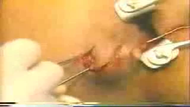 Fistulectomy Surgery