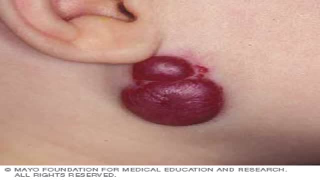 Infantile Hemangiomas