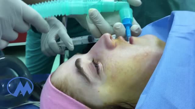 Dental Abscess extending into Submandibular space