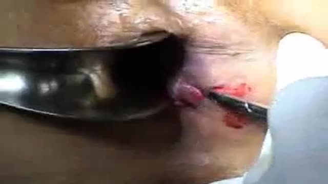 ⁣Lateral internal sphincterotomy