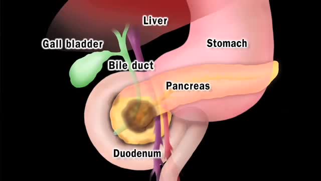 ⁣What is Pancreatic Cancer