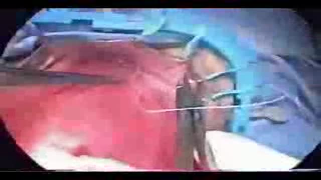 Delorme Operation for Rectal Prolapse