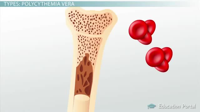 Polycythemia