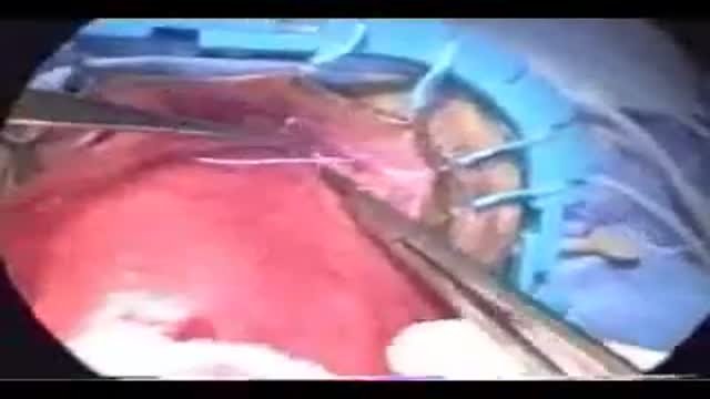 Perineal rectosigmoidectomy