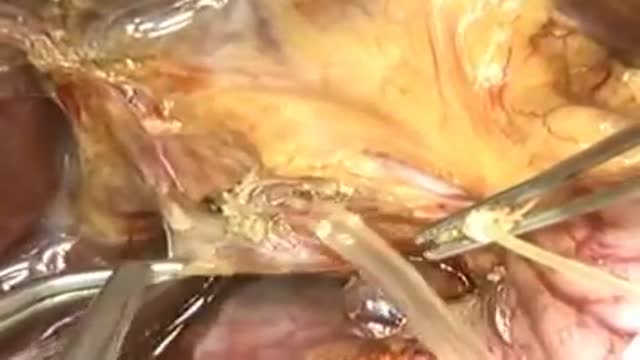 Liver Transplantation