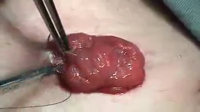 Transverse Colostomy Closure