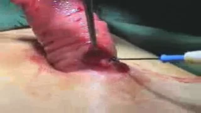 Resection of sigmoid colostomy prolapse