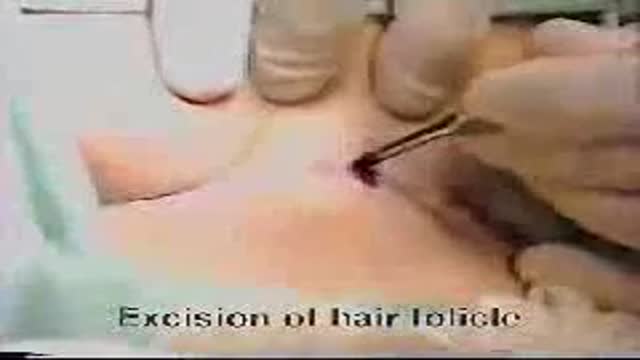 Pilonidal Cyst Removal