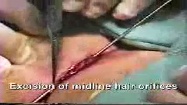 Pilonidal Cyst Removal by Laying Open Technique