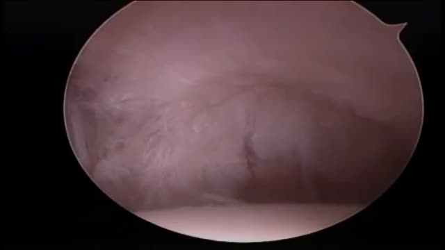 Rotator Cuff Repair Surgery