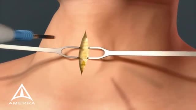 ⁣Tracheotomy Procedure for Airway- 3D Medical Animation