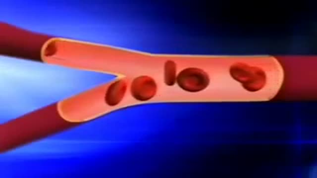 Sickle Cell Disease