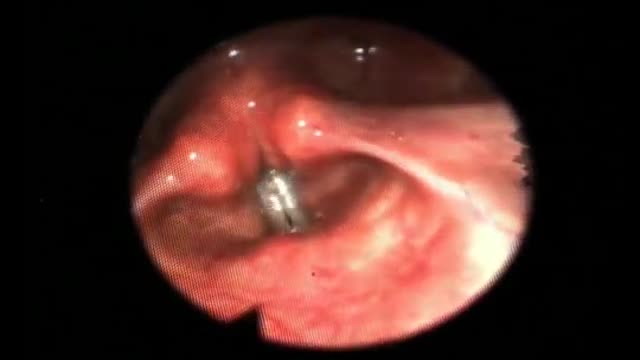 Vocal Cords - While Singing
