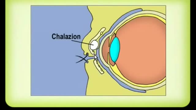 ⁣Chalazion