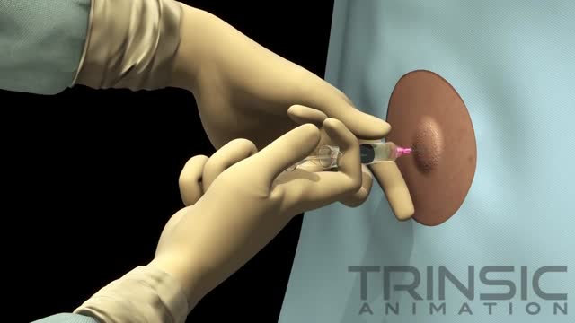 Thoracentesis Procedure