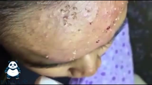 ⁣Severe Acne And Pimples