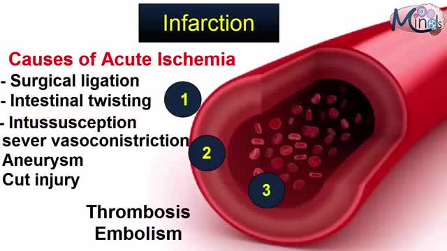 ⁣Infarction