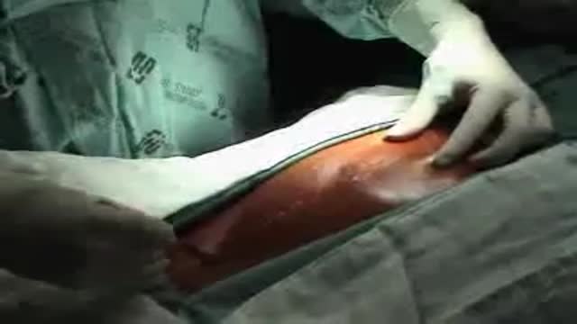 Duhamel's Operation for Chagasic Megacolon