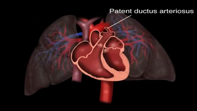 Patent Ductus Arteriosus