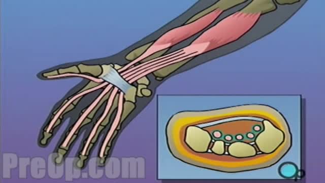 ⁣Carpal Tunnel Syndrome Surgery