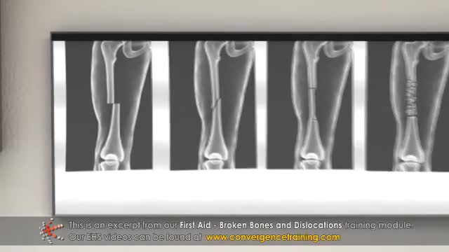 ⁣First Aid - Broken Bones and Dislocations