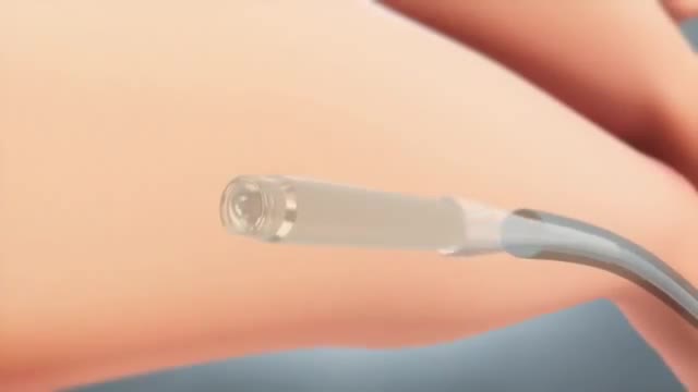 ⁣New Tiny Wireless Pacemaker for the Human Heart