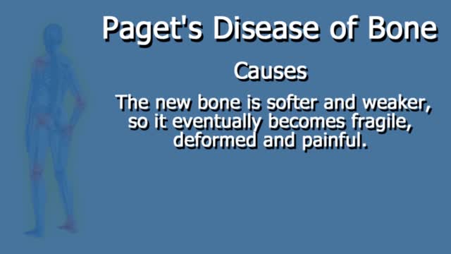 Paget's Disease of Bone