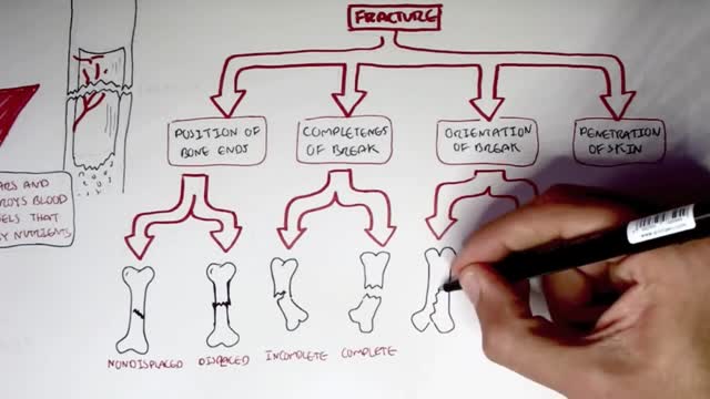 Types of Bone Fracture