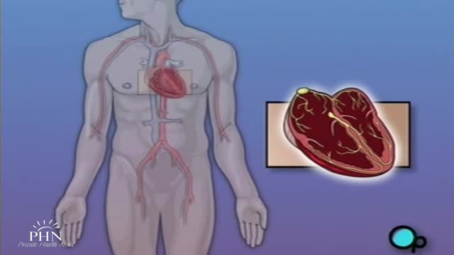 ⁣Permanent Pacemaker Implant