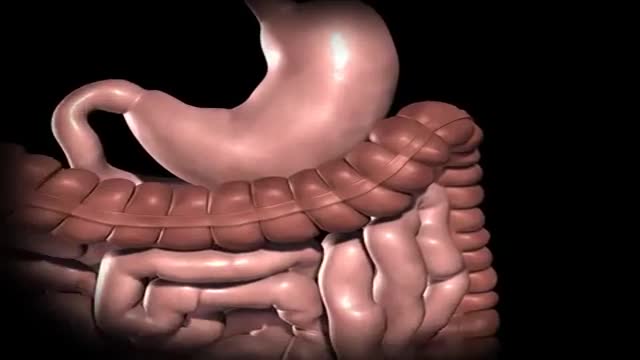 Gastric Bypass