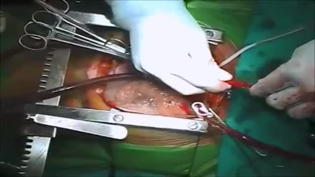 ⁣Closure of post infarction ventricular septal rupture